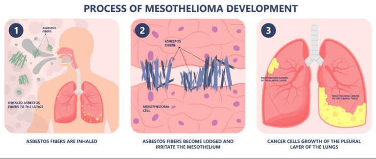 diagram detailing the process of mesothelioma development