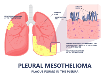 diagram of pleural mesothelioma