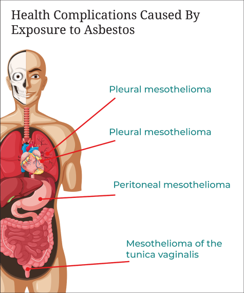 diagram of health complications caused by asbestos exposure
