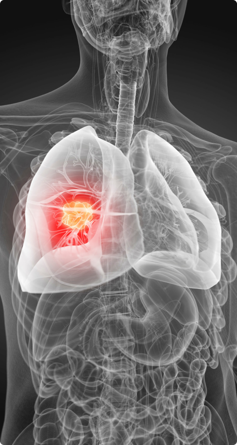 CGI xray of a person with lung cancer