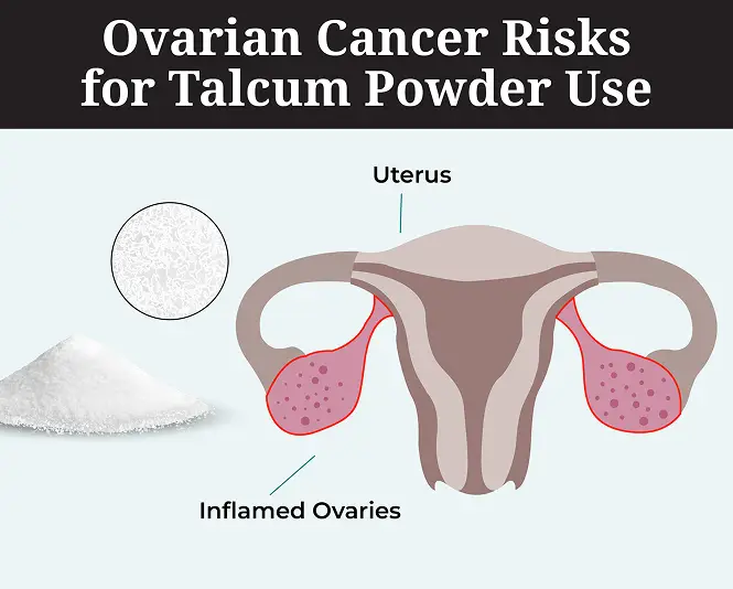 Ovarian cancer risks for talc powder use