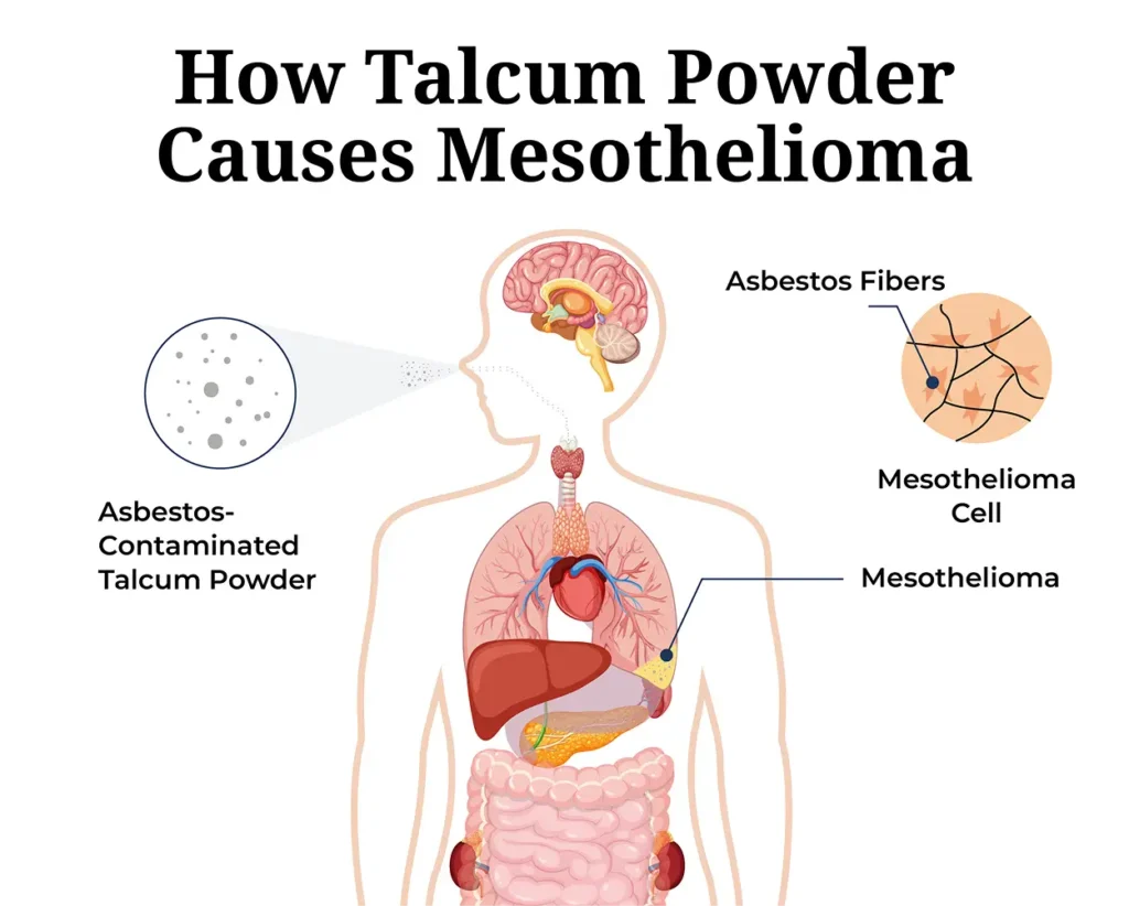 how talcum powder causes mesothelioma